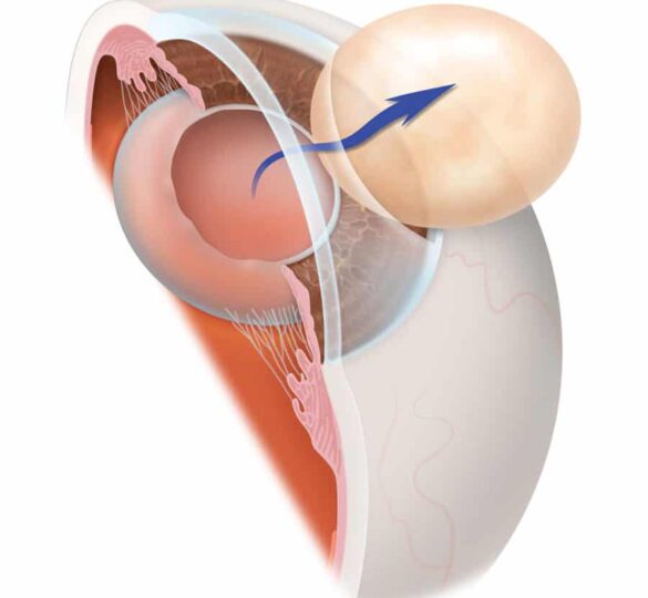 Cataratas Y Glaucoma