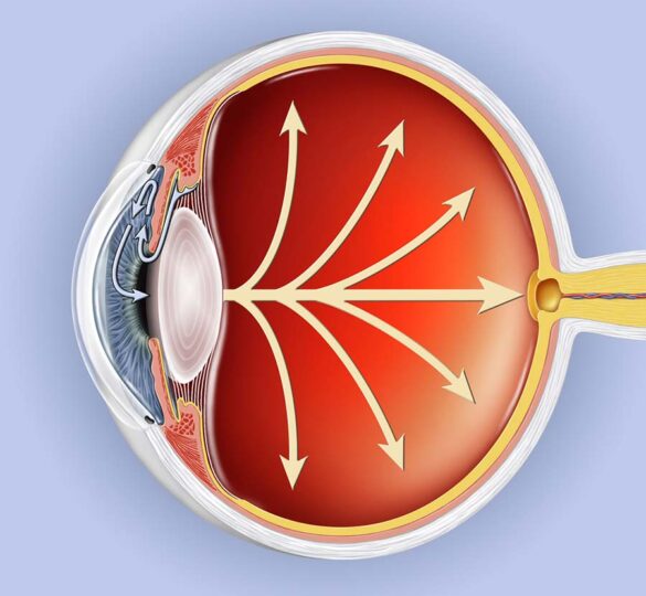 Canaloplasty: A Surgical Alternative For Glaucoma