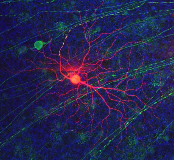 Glaucoma Biomarkers: From The Laboratory To The Clinic