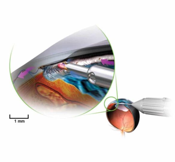 Trabectome Surgery: A Minimally-Invasive Glaucoma Procedure