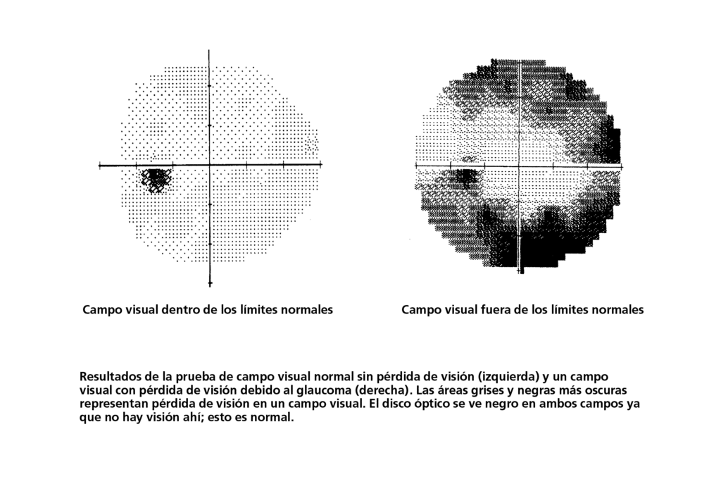 visual field test spanish