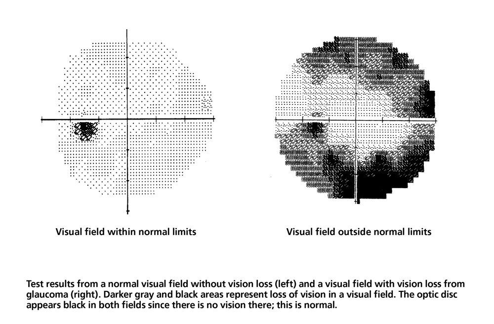 visual field test